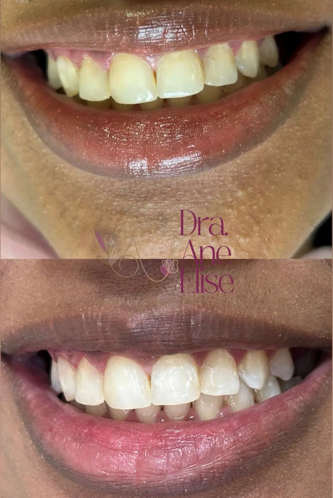 Clareamento dental - antes e depois - Bom Jesus da Lapa