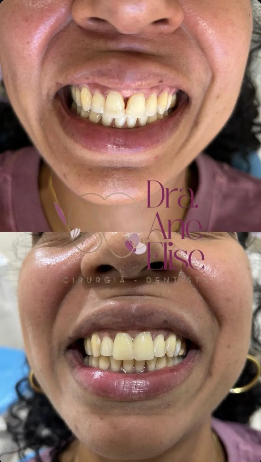 Facetas dentárias - antes e depois - Bom Jesus da Lapa