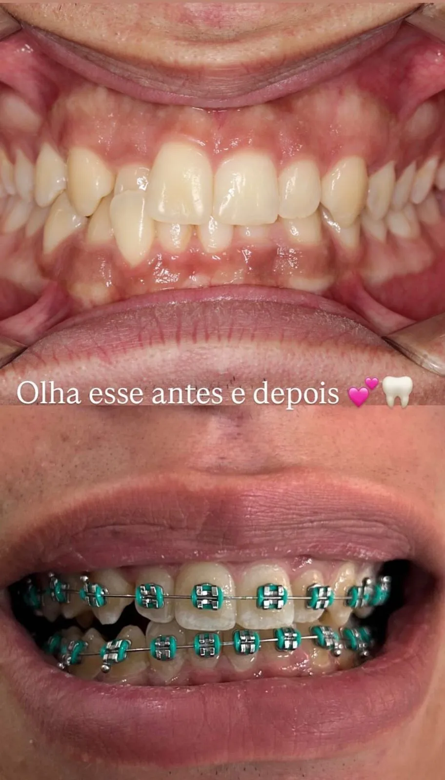 Ortodontia - antes e depois - Bom Jesus da Lapa